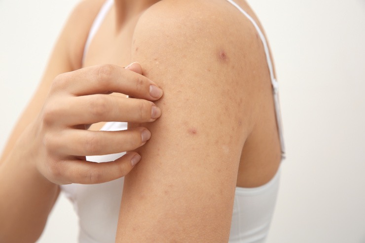 Brufoli e acne estiva: chi colpisce e perché si manifestano